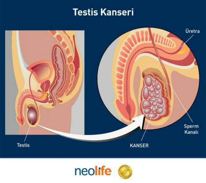 Testis tümörü ve kanseri?