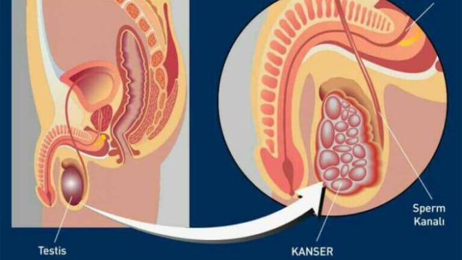 Testis tümörü ve kanseri?