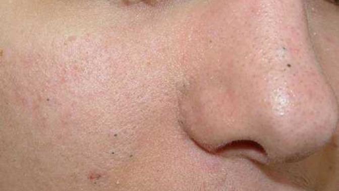 Yüzdeki putürler nasıl geçer tamamen arkadaşlar lutfn yardm?
