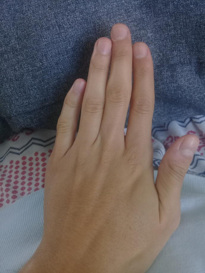 El parmaklarim neden bu kadar yamuk?