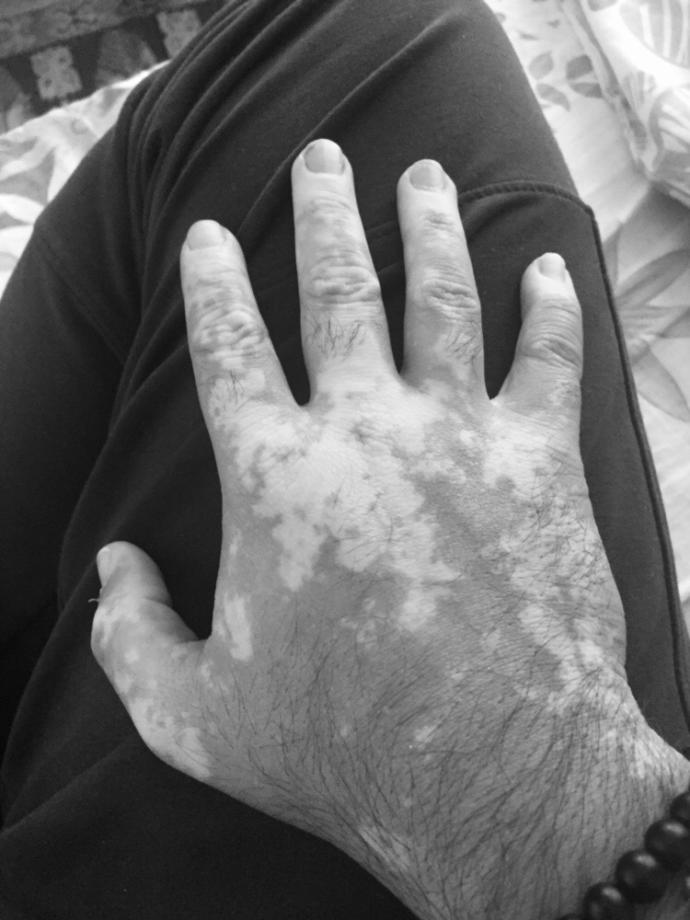 Vitiligo hakkında düşünceniz nedir?
