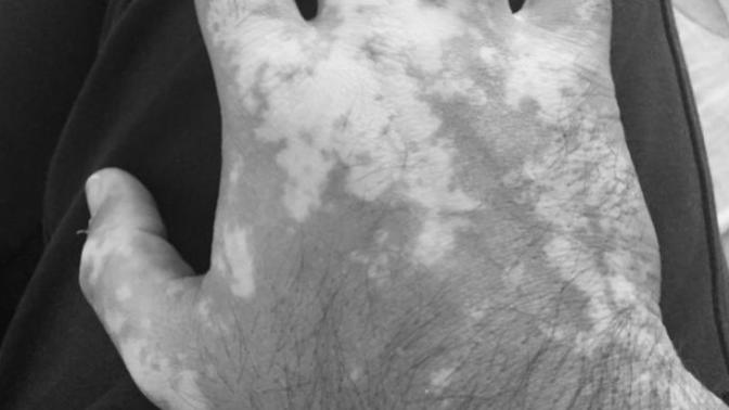 Vitiligo hakkında düşünceniz nedir?