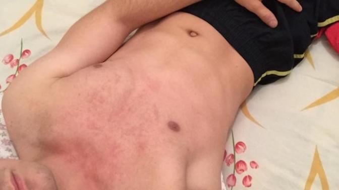 Tüğ dökücü krem alerji yaptı nasıl çözüm aranmalı?