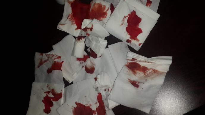 Burun kanamasına sebep olacak neler var?
