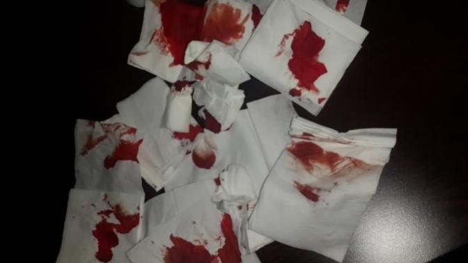 Burun kanamasına sebep olacak neler var?