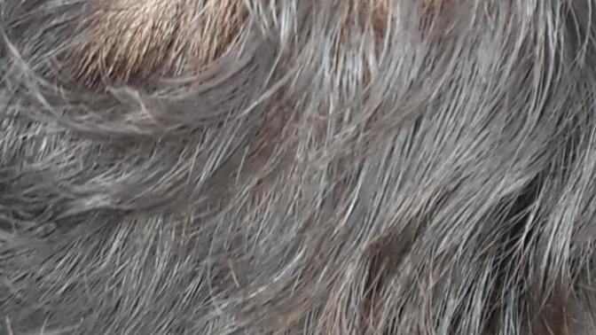 19 yaşındayım ve saçım dökülüyor ne yapabilirim?