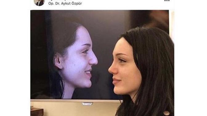Burun estetiği?