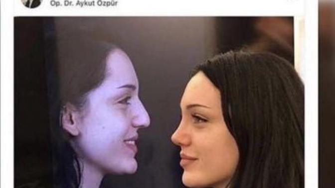 Burun estetigi insani bu kadar değiştirir mi yahu?