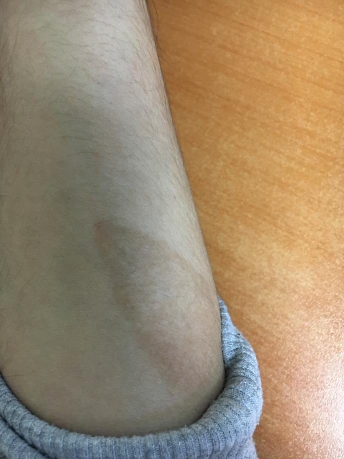 Yanık lekesi geçer mi?