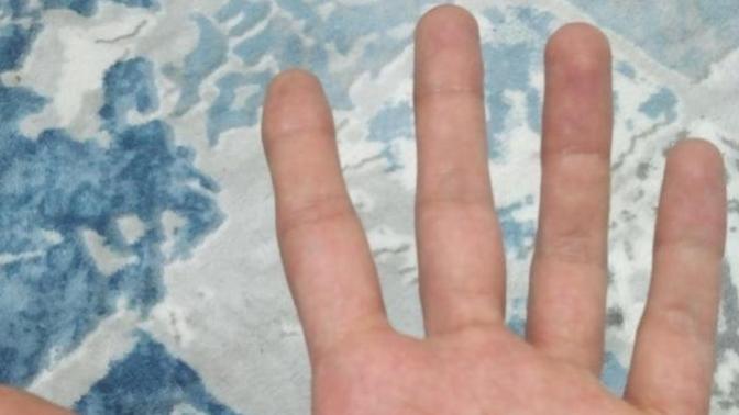 Benim gibi ince bilek ince deri ve kız gibi ince ellere sahip olan bu durumdan muzdarip olan var mı?
