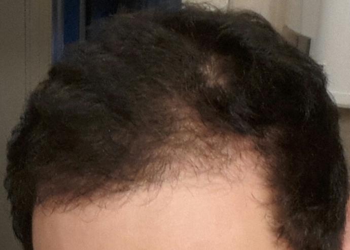 Yaş 26 saçlarımın ön tarafı çok yavaş uzuyor birkaç yıldır ve şu an çok orantısız arka ve yanlar her zamanki gibi ama önler kısa?