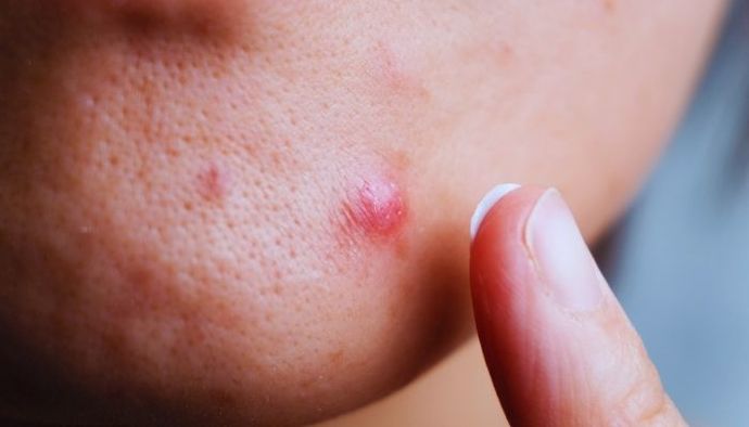 Thiocilline Nedir? Sivilcelere İyi Gelir mi? Yüze Sürülür mü?