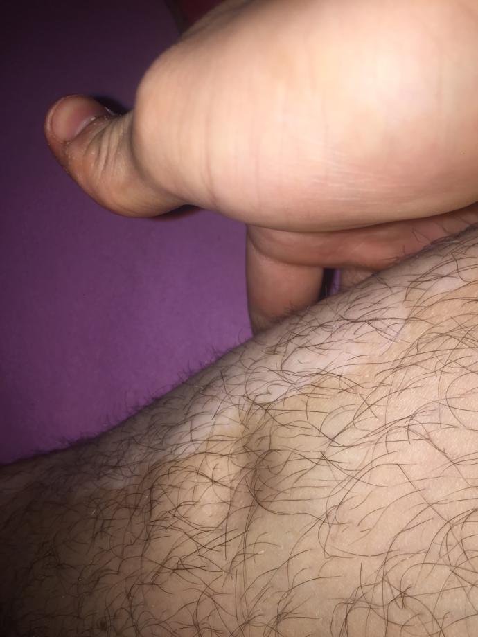 Ön bacakta (kaval kemiğinin üstü) neden çukur oluşur?