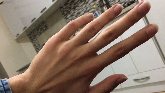 Ellerim çok tahriş oldu. Ne yapmalıyım?