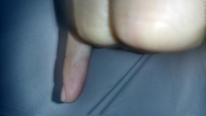 Küçük parmağımda çıkan şey nedir?