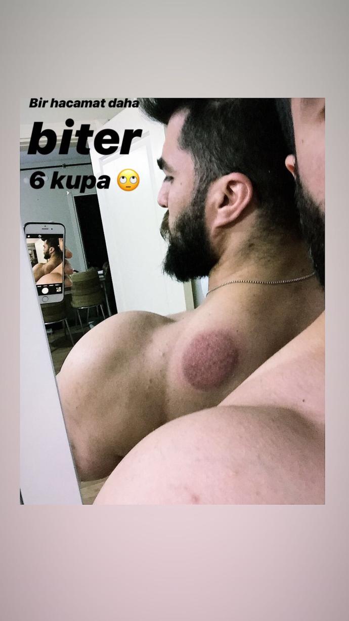 Daha önce hacamat yaptırdınız mi?