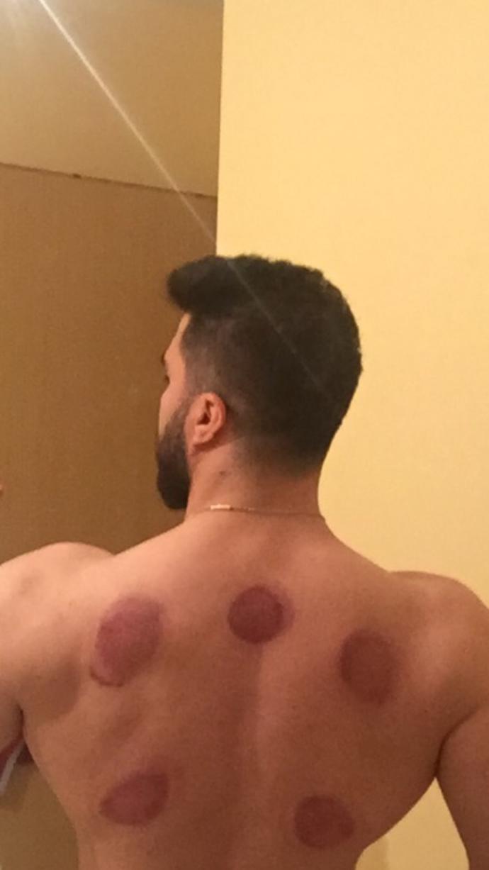 Daha önce hacamat yaptırdınız mi?