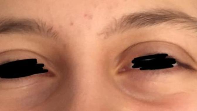 Göz altım zaten mor ve çökük, gülünce şişiyor bide çok çirkin oluyor görseldeki gibi, nasıl geçer bu, gülümseyemiyorum artık?
