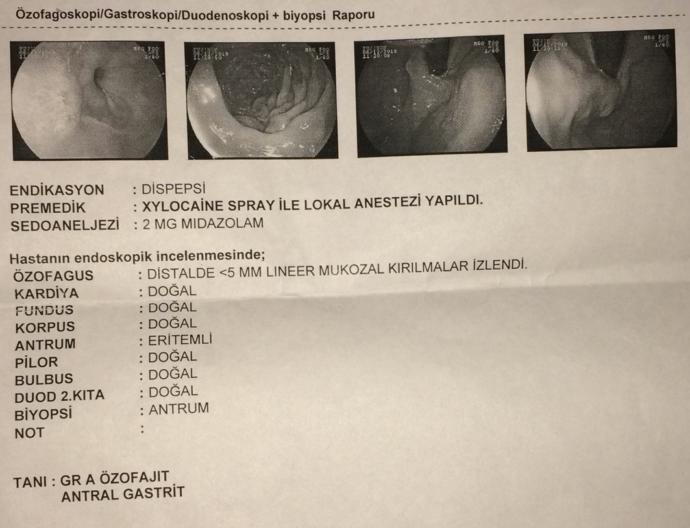 Reflü Benzeri Mide Hastalığı Olanlar Var Mı?