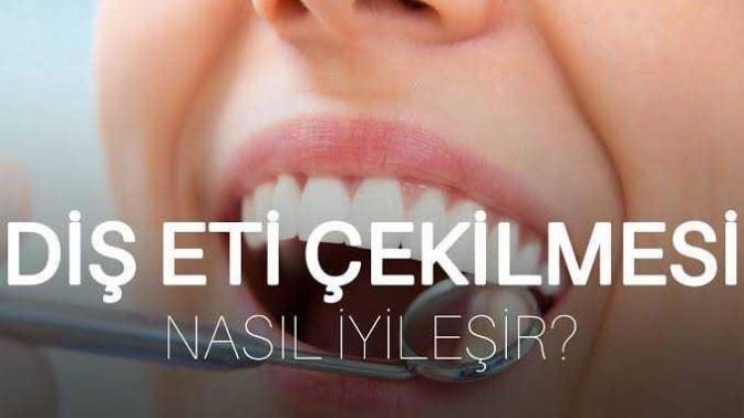 Diş eti çekilmesi var nasıl geçer?