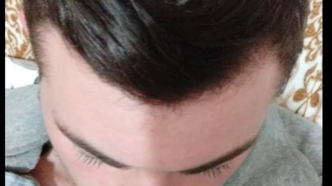 Benim saçım mı dökülüyor bana mı öyle geliyor? Yedi sülalemde kellik yok?