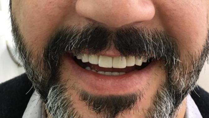 Dişlerim nasıl olmuş?