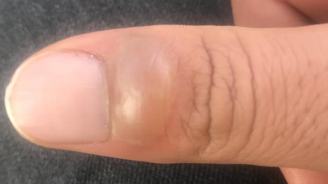 Bakarmısınız Parmağım Böyle Oldu Ne Yapmalıyım?