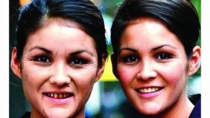 Arkadaşlar bu arkadaşlar 2 lermiş aigara içen ve içmeyen ikizler aradaki farkları görüyorsunuz artık sigarayı bırakırmısınız 😏 ?