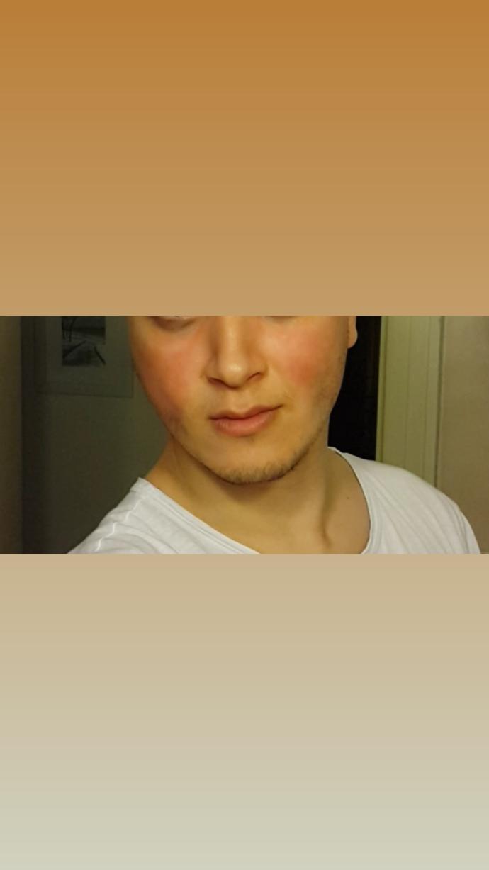 Elma yanaklımıyım yanaklarım çok tombulmu? Yağ oranım %25 e yakın göbek var biraz boy 196 kilo 94. Sporla erirmi yağ azalinca yüz?