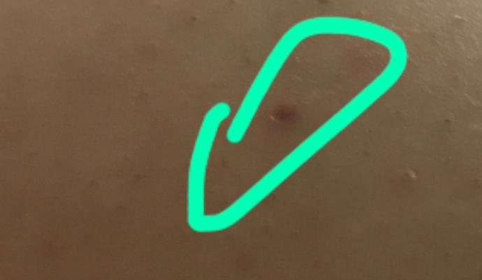 Arkadaşlar lazer epilasyon benlere bişe yaparmı?