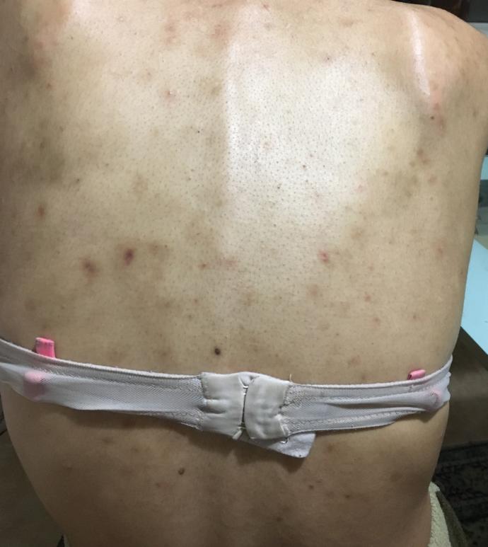 Roaccutane kullanıyorum (akne ilacı) fakat sırtımda bir sürü leke var görselde gördüğünüz gibi ağır şekilde bunlarda hafifler mi?