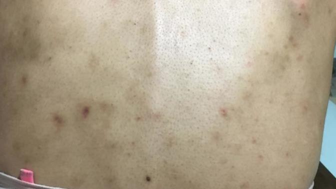 Roaccutane kullanıyorum (akne ilacı) fakat sırtımda bir sürü leke var görselde gördüğünüz gibi ağır şekilde bunlarda hafifler mi?