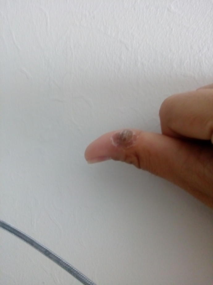 Geçmeyen siğilim (resimli)?