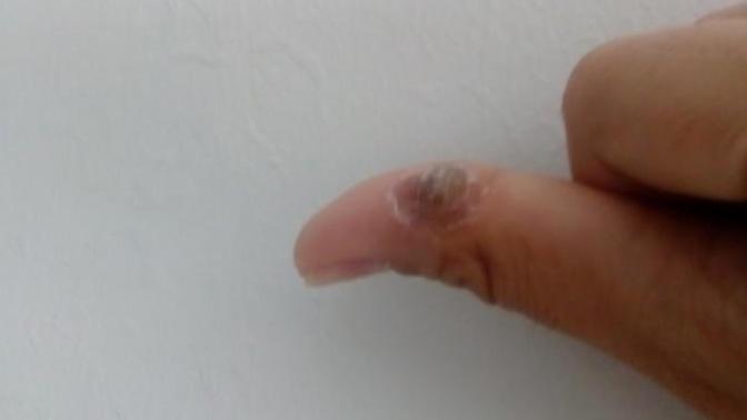 Geçmeyen siğilim (resimli)?