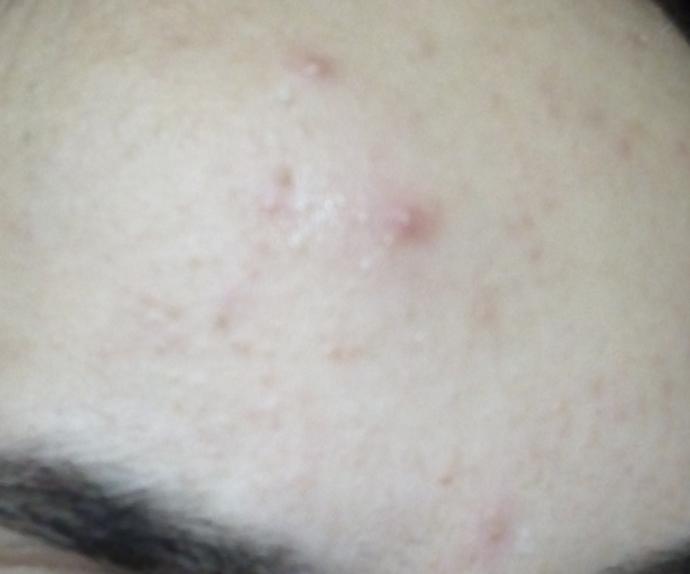 Cildim (fotoğraflı) çok mu kötü? Nasıl düzelebilir?