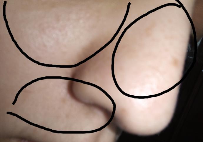 Cildim (fotoğraflı) çok mu kötü? Nasıl düzelebilir?