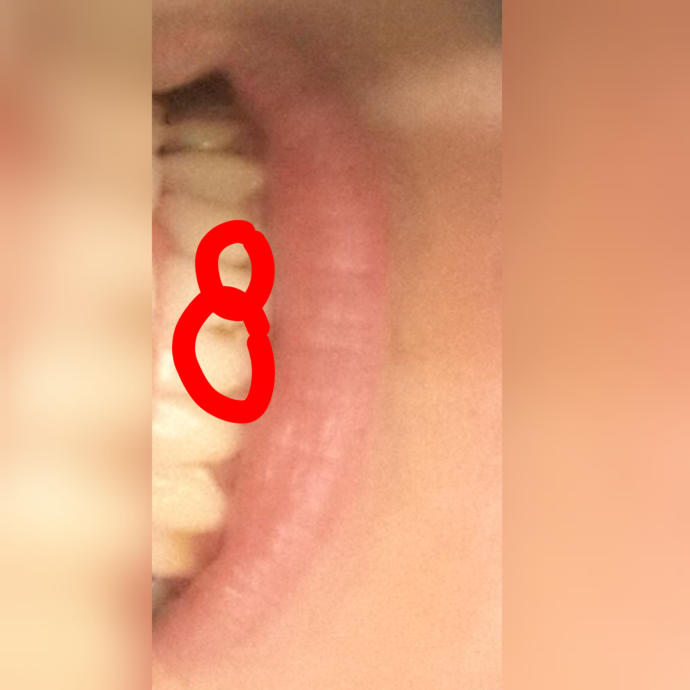 Resimli Alt dislerimin arasi en dibinde böyle siyah noktalar var gitmiyor ve sizce bu nedir?
