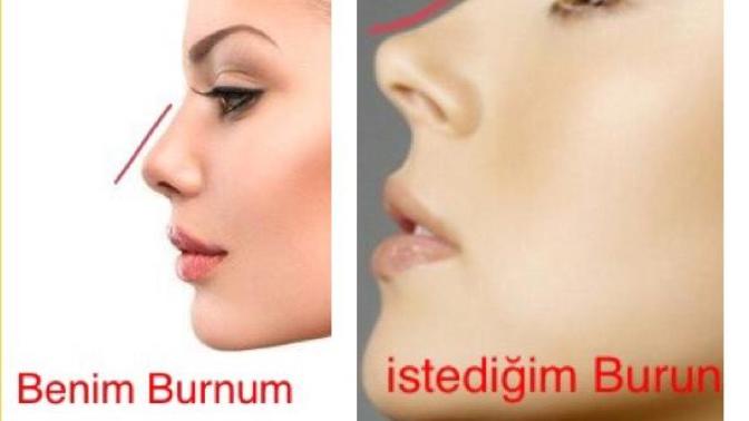 Arkadaşlar, burun ameliyatı çokmu zor, burnum güzel ama ben beğenmiyorum, kıvrımlı burunları çok beğeniyorum, ameliyata değer mi?