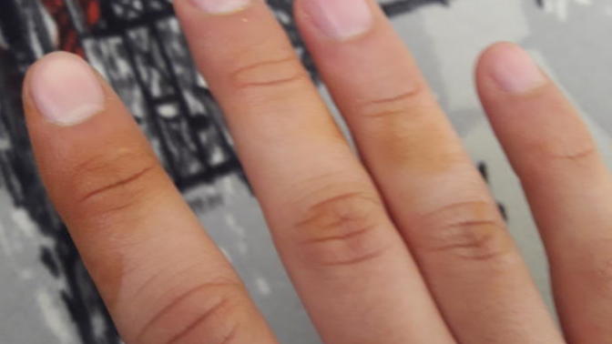 Elimde Sarı Rengi gibi morluk gibi birşeyler çıktı sizce ne olabilir?