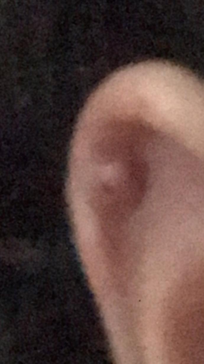 Piercing iltihabı nasıl geçer?