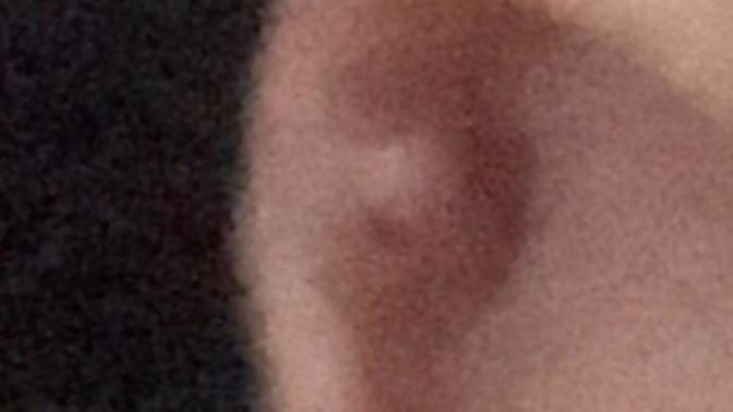 Piercing iltihabı nasıl geçer?