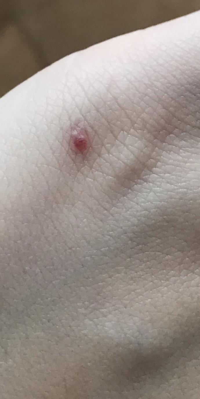 Ciltteki kırmızı noktalar?