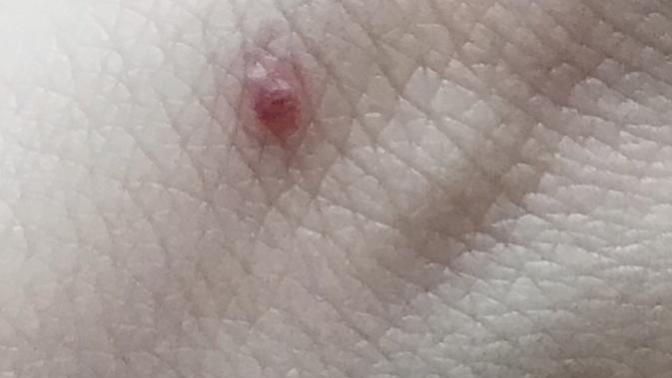 Ciltteki kırmızı noktalar?