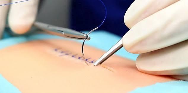 Dikiş ne zaman alınır ve dikiş olan yere kaç gün su değmez?