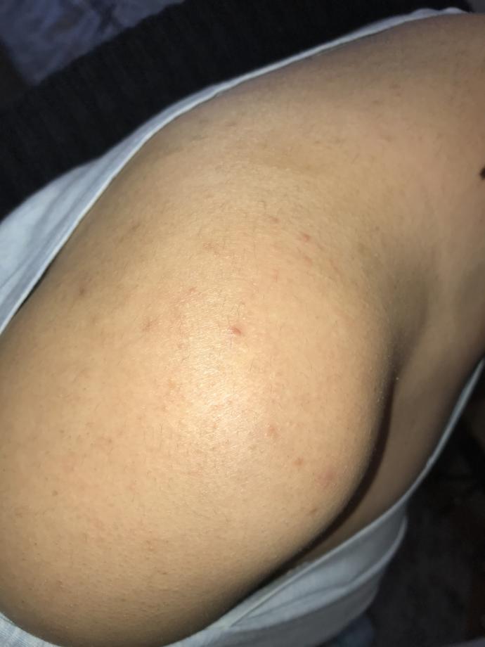 Lazere gidiyorum ama beklediğim azalmayı alamadım sizce nasıl?