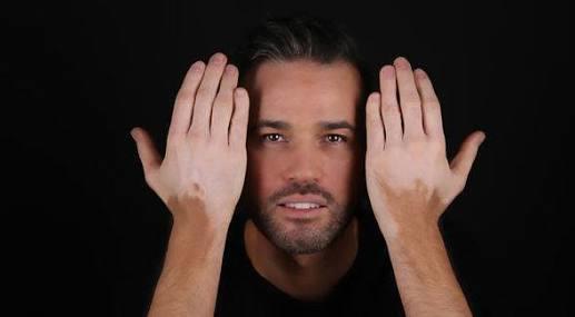 Vitiligo olan biriyle evlenir misiniz?
