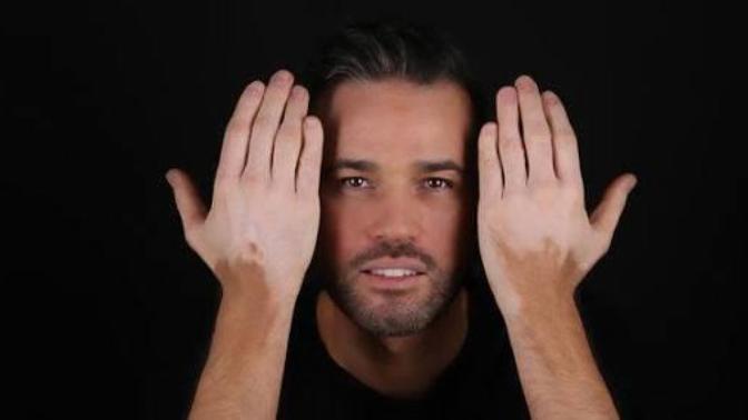 Vitiligo olan biriyle evlenir misiniz?