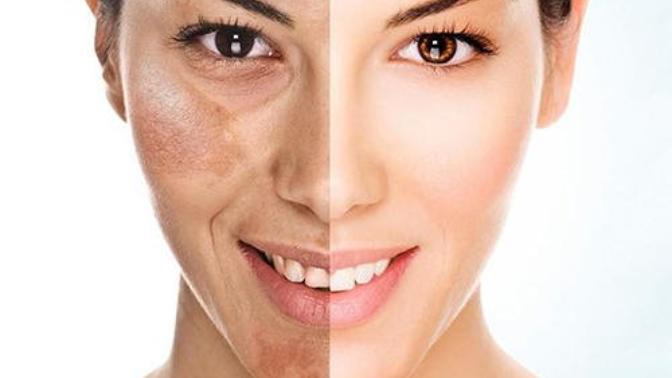 Kolajen (Collagen) Takviyesi nedir? Kollagen kime faydalıdır?