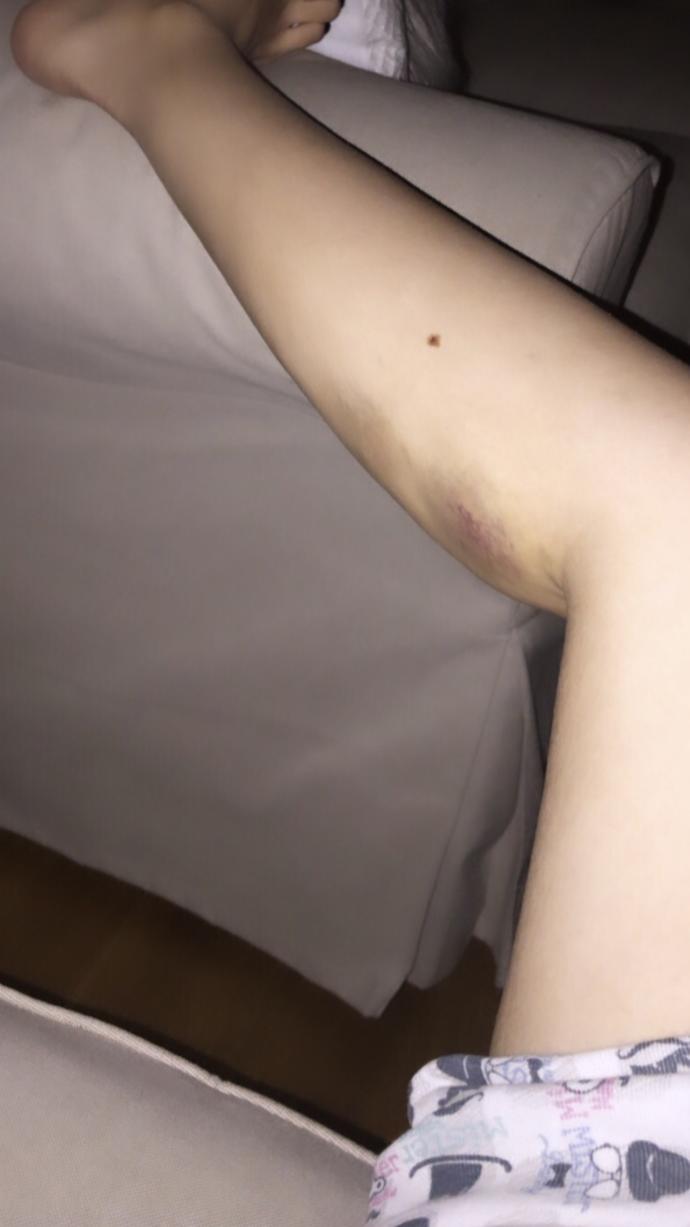 Bacakta nedensiz kocaman morluk?