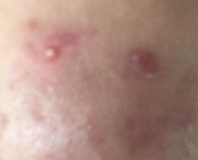 Zoretanin - Roaccutane kullanan var mı?